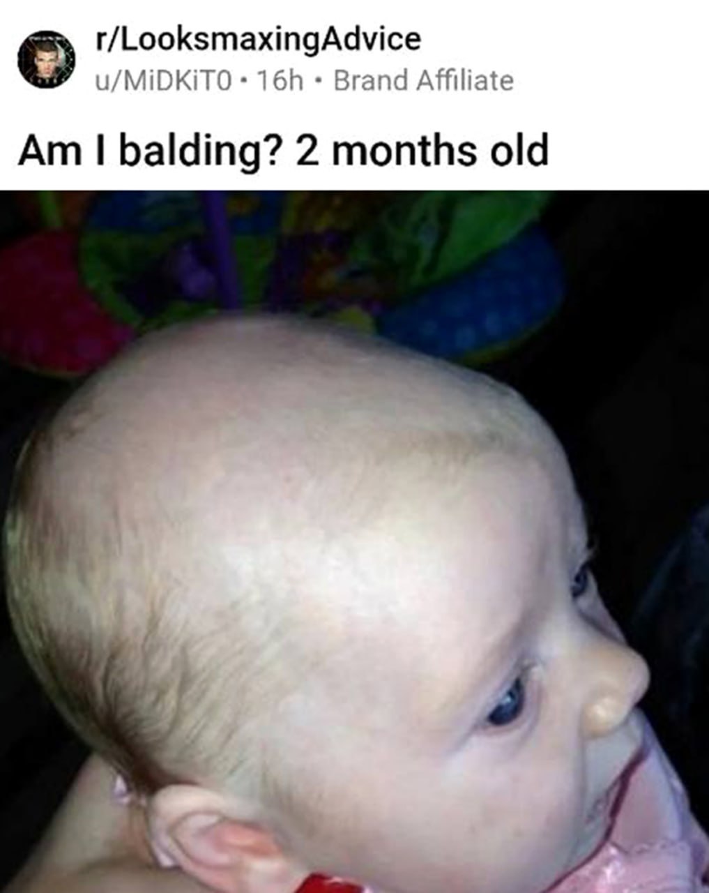 Am I balding? 2 months old Я лысею? 2 месяца