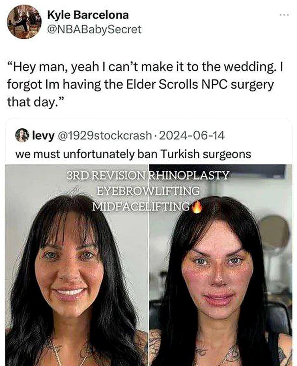 Elder Scrolls NPC surgery Женщина до и после множественных пластических операций, после которых она стала похожа на NPC из игры Elder Scrolls.