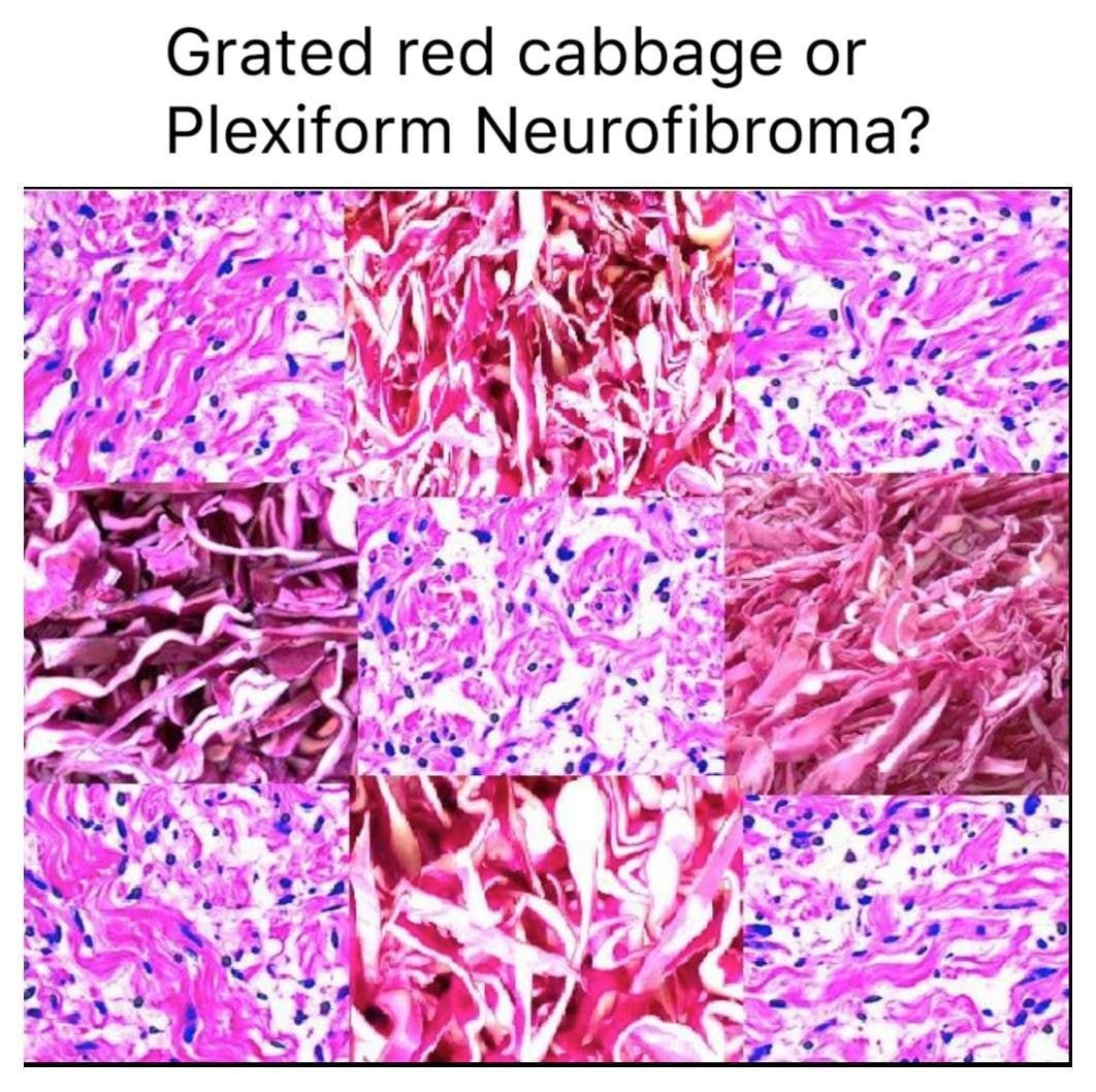 Коллаж из розово-фиолетовых гистологических снимков с подписью «Grated red cabbage or Plexiform Neurofibroma?», где ткань сравнивают с тертой красной капустой.