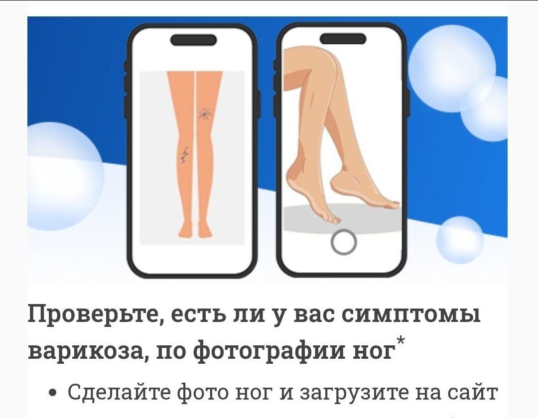Странная реклама проверки симптомов варикоза по фотографии ног на смартфоне