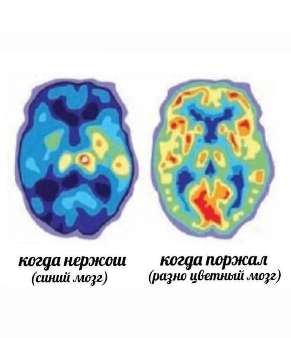 Когда поржал (разноцветный мозг) Снимок мозга, показывающий разницу в активности мозга, когда не смеешься и когда смеешься.
