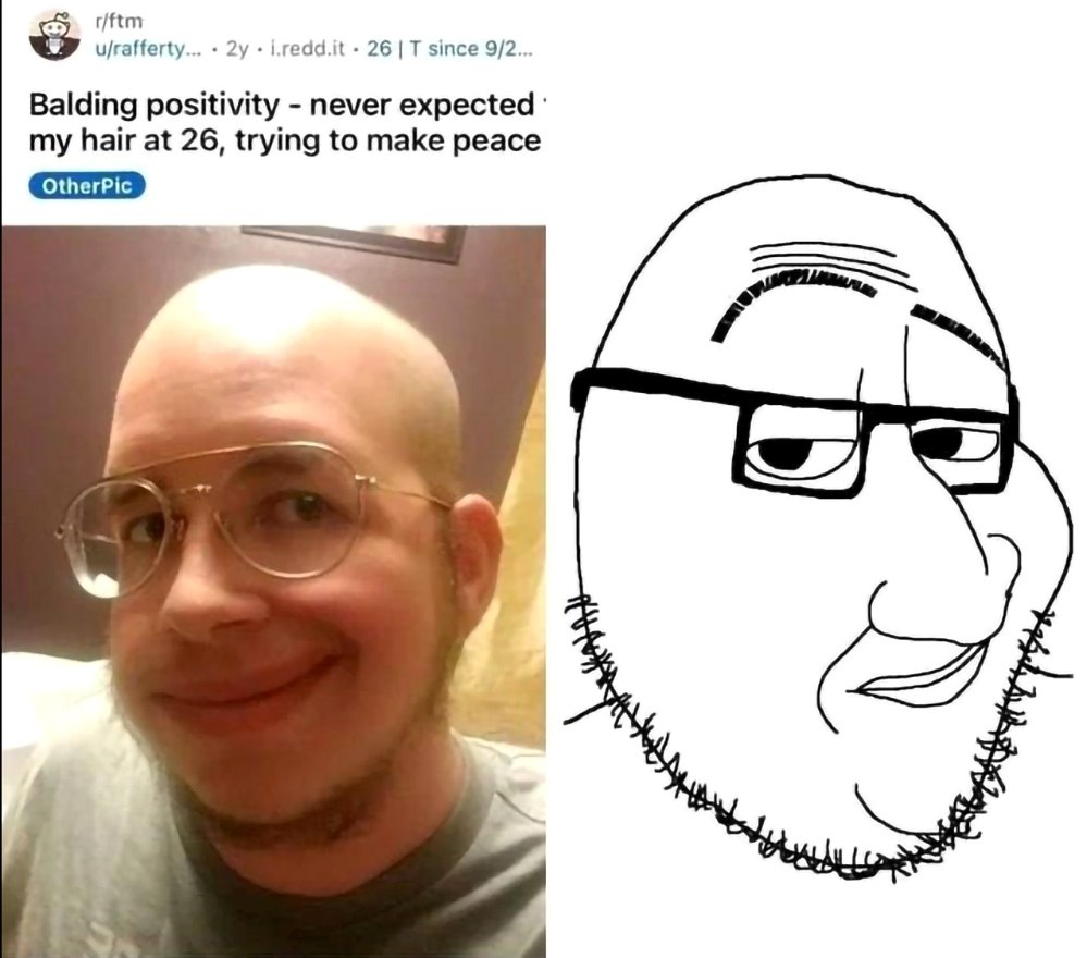 Wojak Balding Positivity Wojak Balding Positivity — лысеющий мужчина в очках, который смирился с потерей волос.